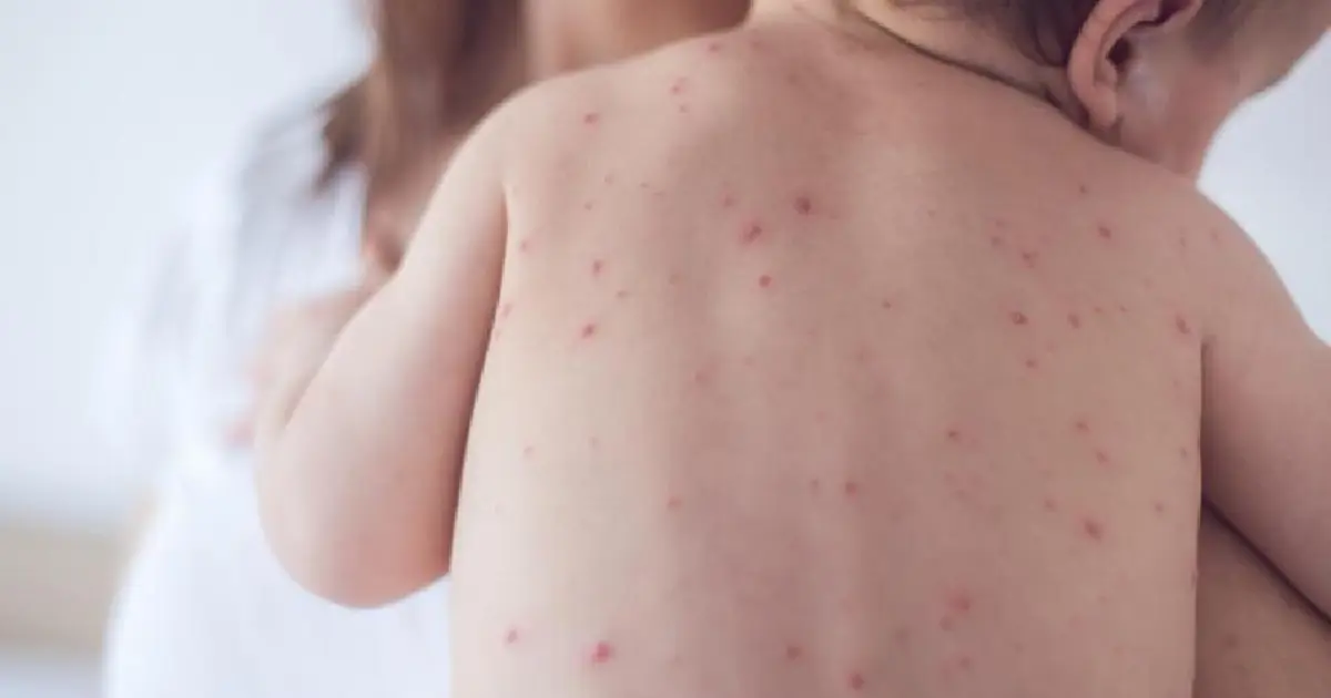 दादुराका ६७ बिरामी उपचारपछि घर फर्के, २० जनाको ‘आइसोलेसन’ उपचार जारी